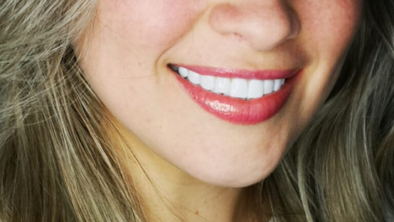 Lee más sobre el artículo La vida después de un Diseño de Sonrisa