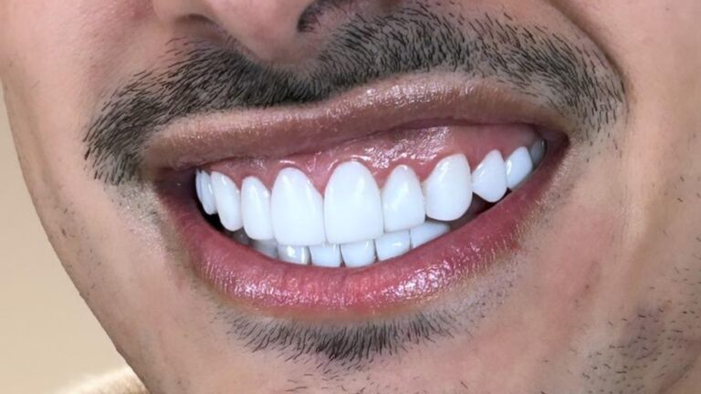 Lee más sobre el artículo Cuidados y tips para mantener tu diseño de sonrisa impecable