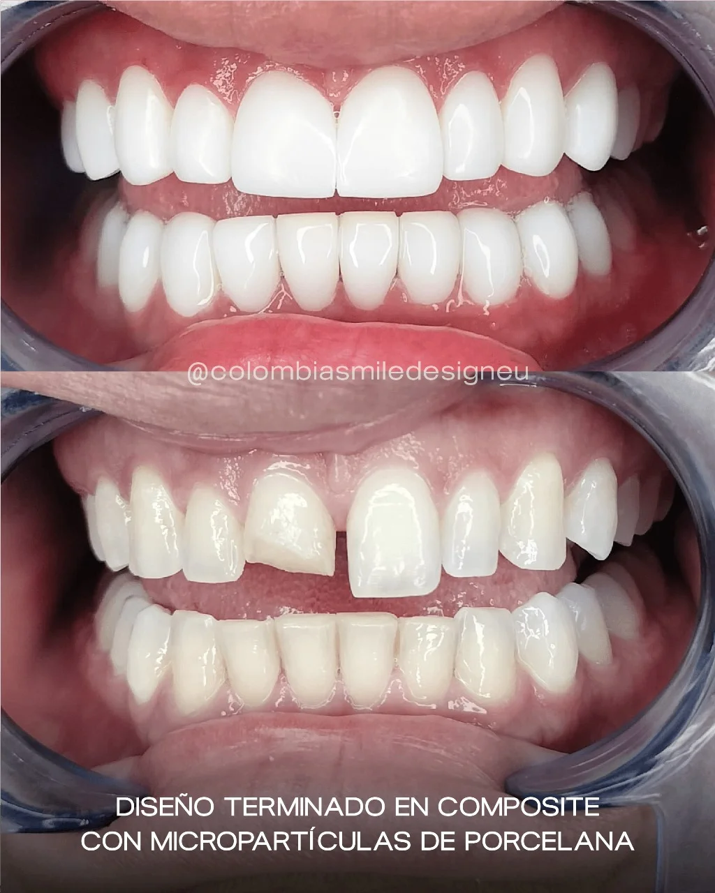 Caso 3 - Composite con micropartículas de porcelana