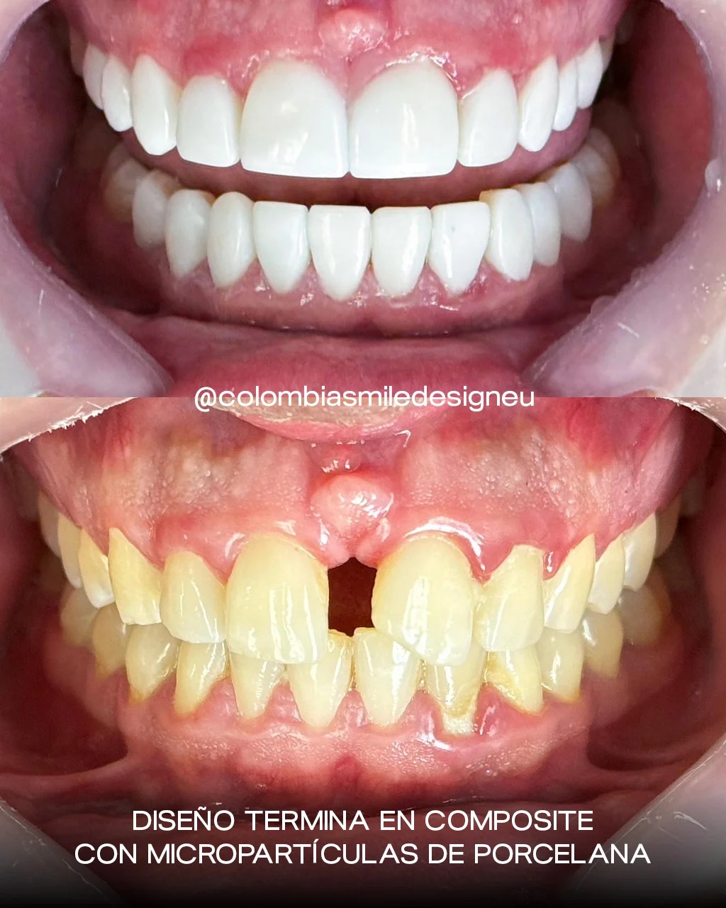 Caso 2 - Composite con micropartículas de porcelana