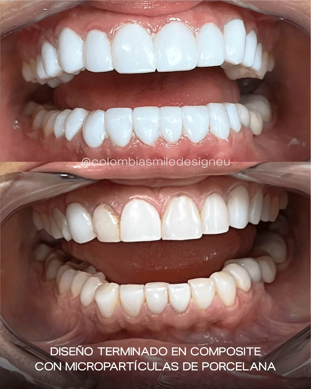 Caso 1 - Composite con micropartículas de porcelana